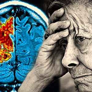 Sleep depravation and Alzheimer disease